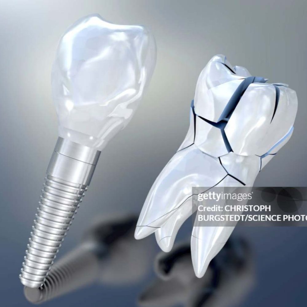 Leistungen-Implantologie-web